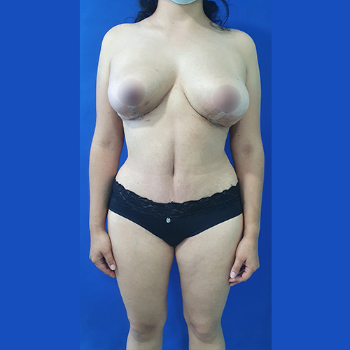 Paciente 10 resultado de abdominoplastia