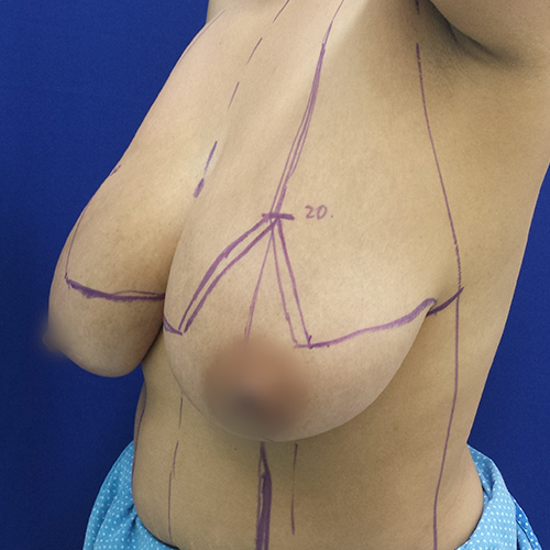 Paciente 1 antes de una mamoplastia de reducción