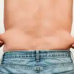 Qué es la abdominoplastia o lipectomia