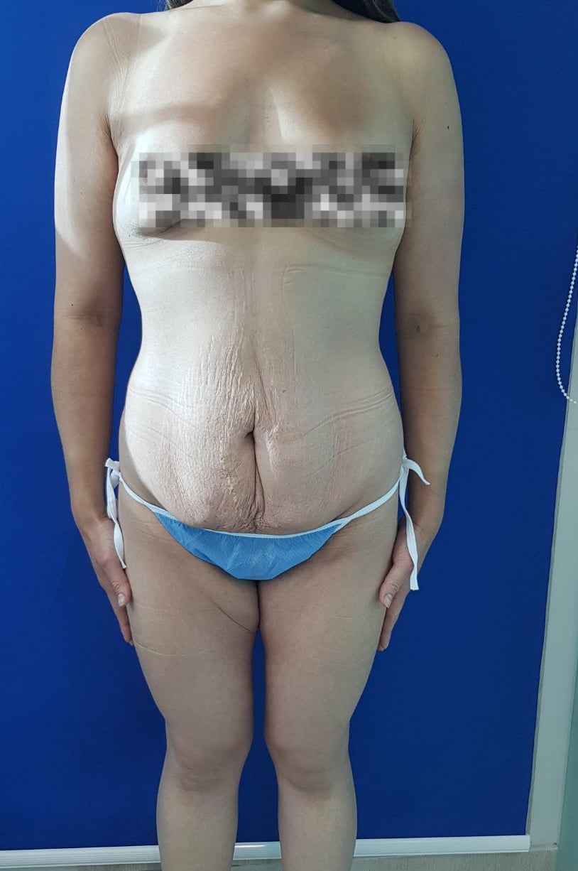 Final Antes Foto woman