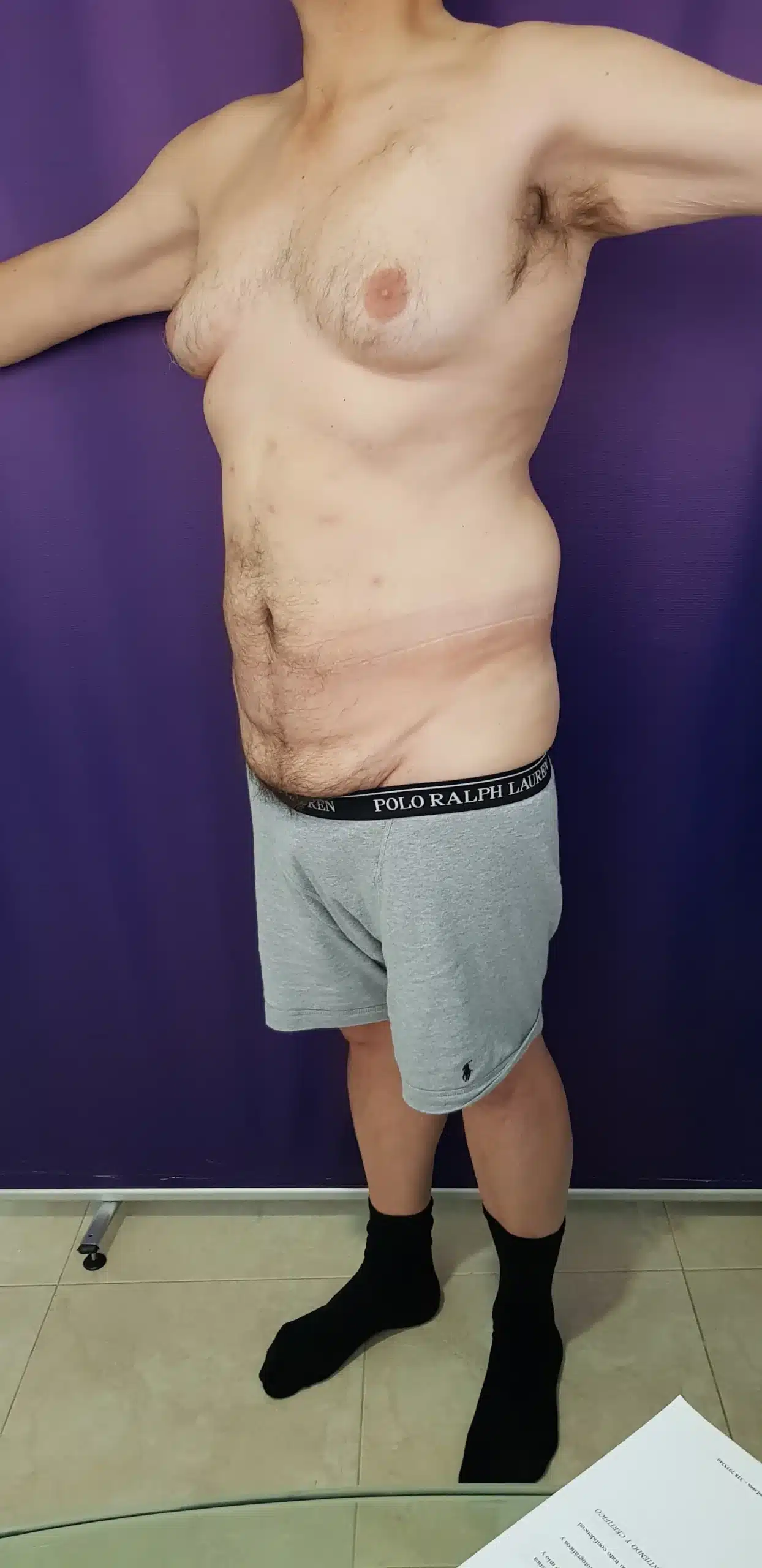 Resultados de cirugía postbariátrica en abdomen y brazos después de pérdida de peso